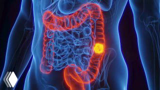 Медицинская 3D-иллюстрация брюшной полости с подсвеченным толстым кишечником и яркой меткой опухоли в сегменте ободочной кишки.