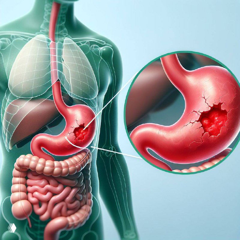 Иллюстрация пищеварительной системы с увеличенным изображением слизистой желудка и явным язвенным или эрозивным поражением на стенке органа