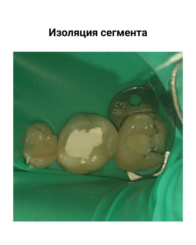 Изображение изоляции сегмента: зелёный коффердам вокруг трёх соседних зубов (5‑й, 6‑й, 7‑й), хорошо видны края коронок и доступ к полости.