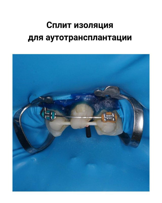 Сплит‑изоляция для аутотрансплантации: коффердам, шина и ортодонтические элементы вокруг пересаживаемого зуба, показана фиксация и работа в сегменте.