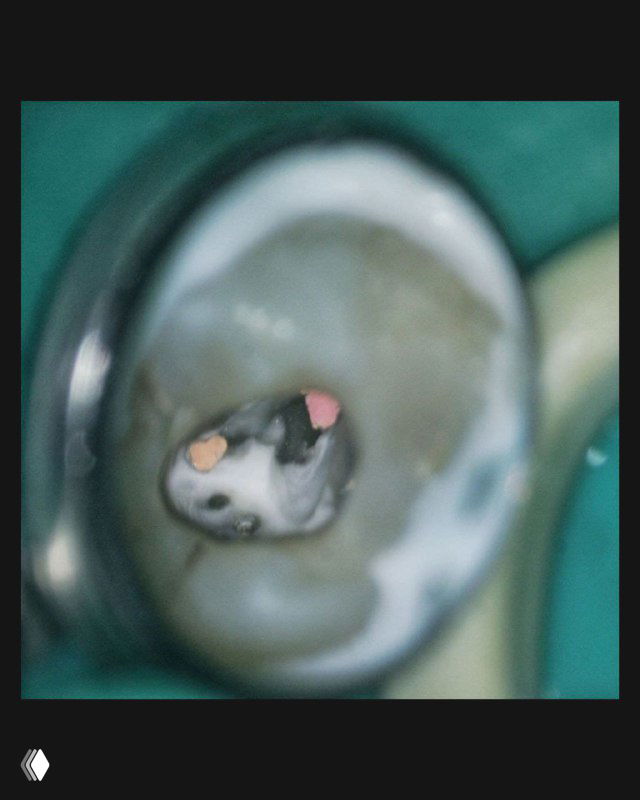 Крупный план операционного поля зуба при эндодонтическом доступе: видна полость, тёмное дно и светлые стенки, заметен маркер устья канала.