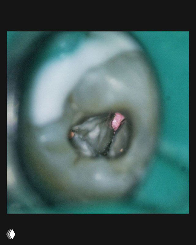 Макрофото коронковой части зуба с открытыми перешейками и видимыми устьями; демонстрация ориентира в условиях облитерации.