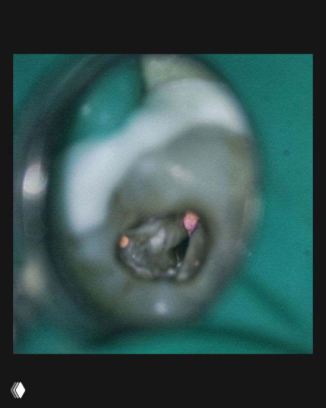 Операционный кадр с доступом к корневому каналу после удаления белого дентина: видна тёмная линия перешейка как ориентир устья.