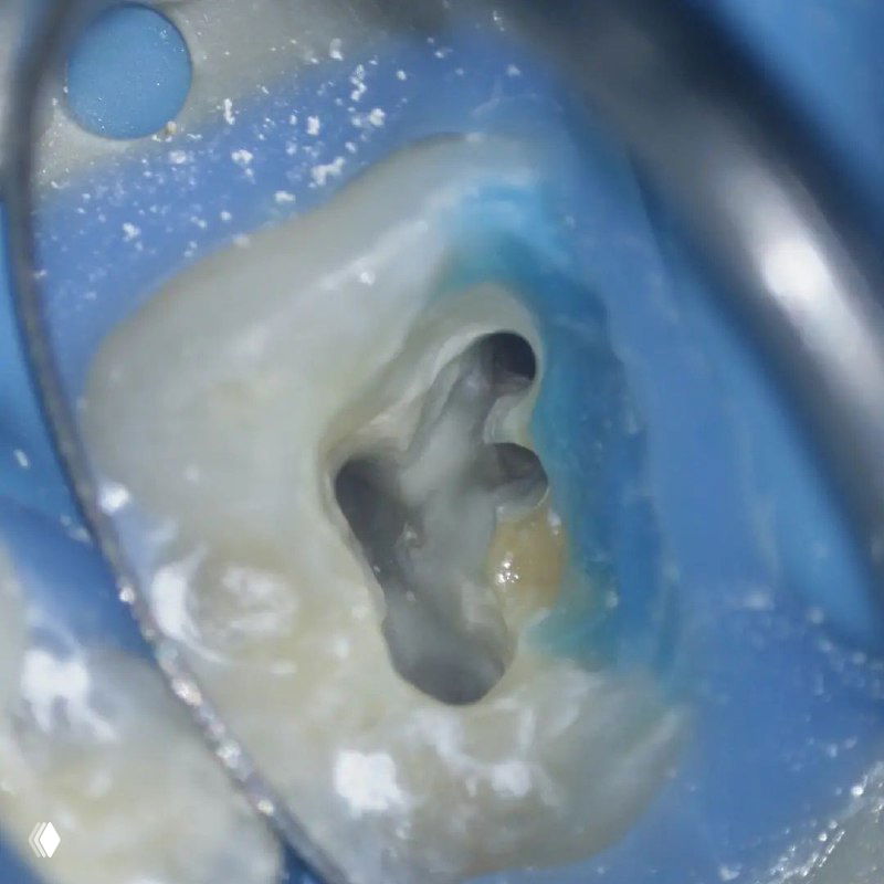 Макрофотография доступа верхнего моляра под микроскопом: видна полость и устье MB2 в классическом положении рядом с MB1, коффердам и стенки полости.