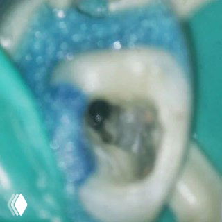 Крупный план рабочего поля: устье MB2 частично отходит из MB1, видны следы препарирования, коффердам и изолированное операционное поле.