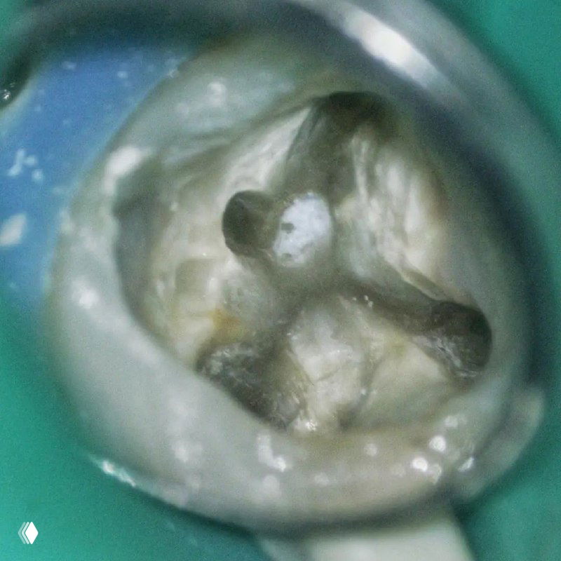 Фото рабочего поля с коффердамом: устье MB2 расположено рядом с небным каналом, хорошо видна анатомическая близость и направление каналов в корне.