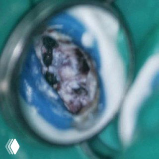 Клинический снимок под микроскопом: обнаружен неожиданный дополнительный канал MB3, демонстрирующий вариабельность корневой анатомии верхнего моляра.