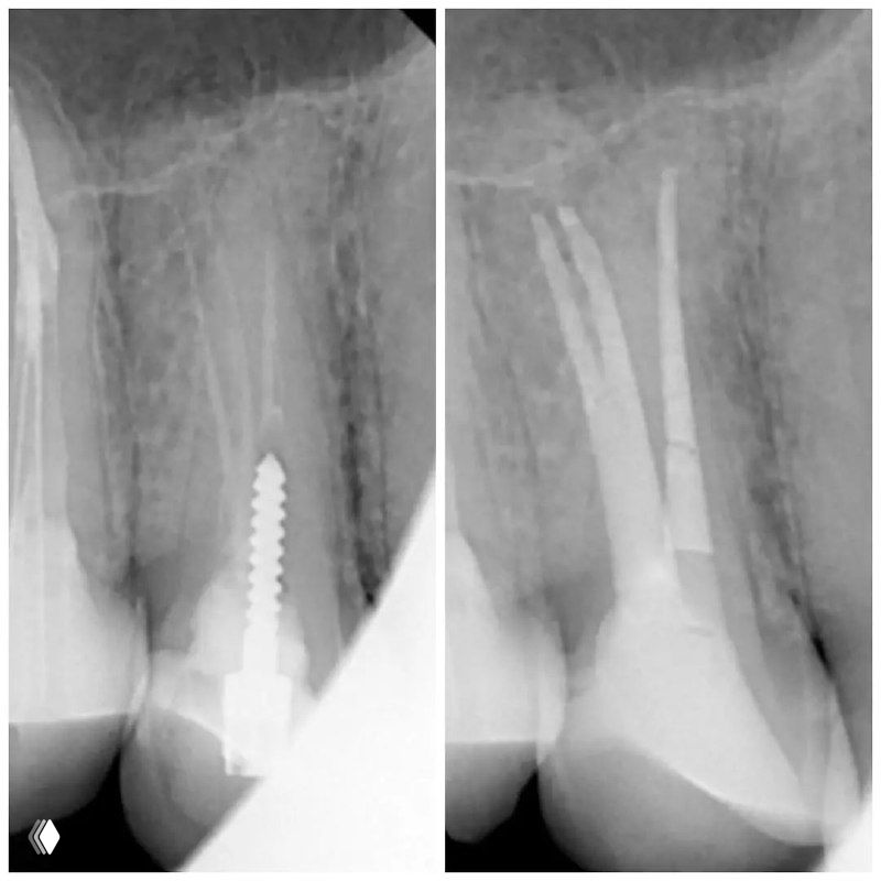 Рентгенограмма премоляра с корневым каналом и фиксацией внутрикорневого штифта; видно пломбировочный материал и анатомию щёчных каналов