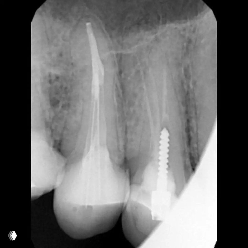 Ортопантомографическая фрагментарная рентгенограмма премоляров с видимыми инструментами и заполнением каналов в области щёчных корней