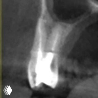 КТ/срез или боковой рентген премоляра, показывающий строение корней и плотность дентина вокруг щёчных каналов