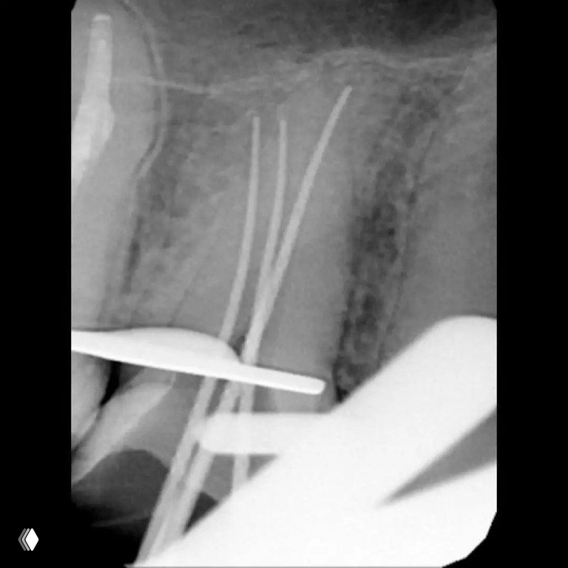 Рабочая рентгенограмма с файловыми штифтами в двух щёчных каналах премоляра, видна техника измерения и позиционирования инструментов