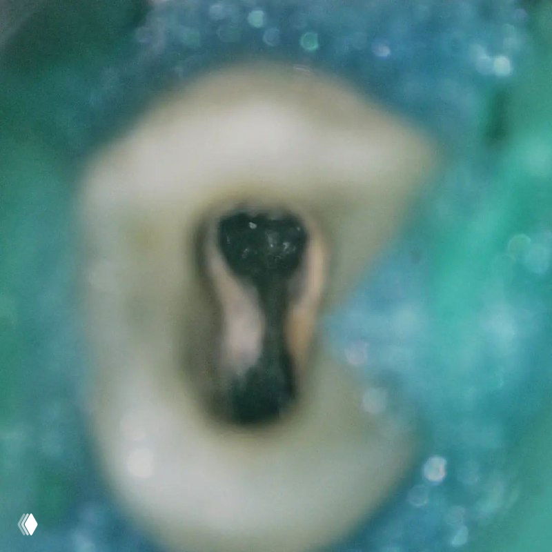 Интраоральная макрофотография полости доступа премоляра с видимыми отверстиями щёчных каналов и резиновой кофердам-изоляцией