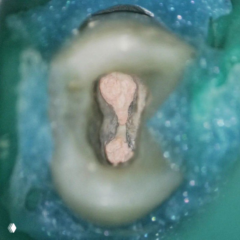 Крупный план полости доступа премоляра с уже выполненной обтурацией в виде компактации; виден контур каналов и материал пломбировки