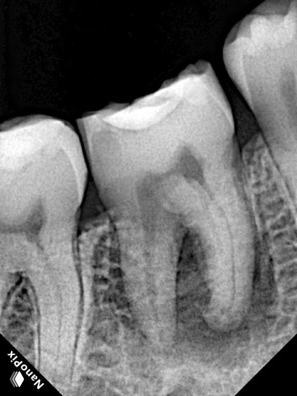 Прицельный рентген зуба после аутотрансплантации, видно форму корня, плотность костной ткани и состояние соседних зубов на ретравизите.
