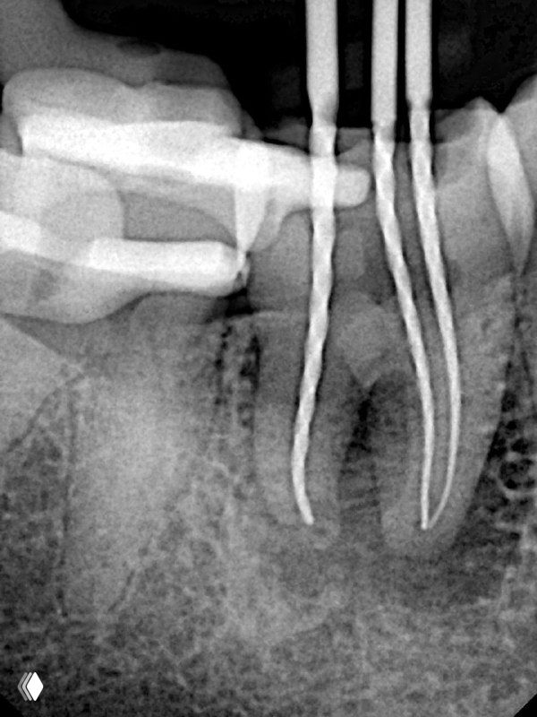 Рентген с рабочими инструментами в корневых каналах: файлы разной длины, видно сложную конфигурацию каналов восьмерки и доступ для препарирования.