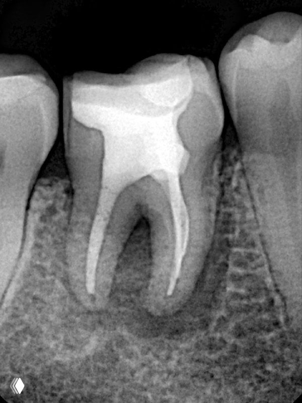 Контрольная рентгенограмма после обтурации вертикальной компакцией гуттаперчи — видна плотность обтурации и адаптация пломбы внутри каналов.