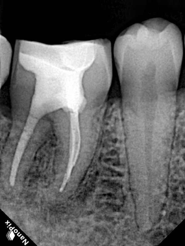 Финальный контрольный снимок: виден билдап и пломбирование коронковой части, оценка краевой адаптации реставрации и состояния окружающей кости.