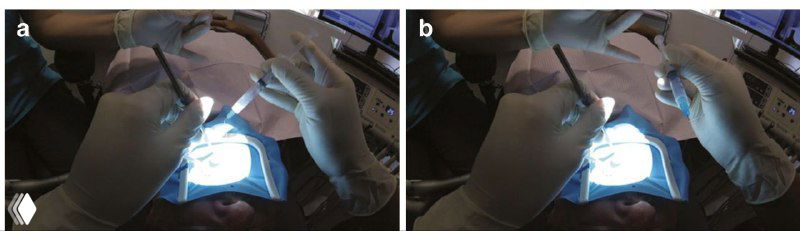 Ассистент и оператор под микроскопом во время ирригации; видна передача шприца и положение рук в полости рта пациента.
