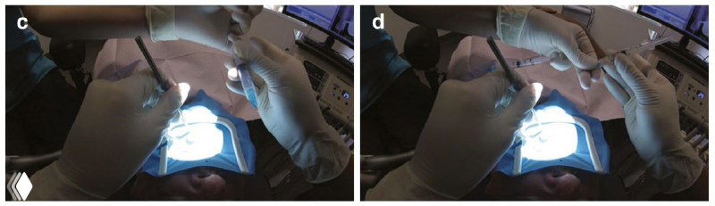 Серия кадров обмена ирригационным раствором: движения оператора и фиксация использованного шприца ассистентом у ладони.