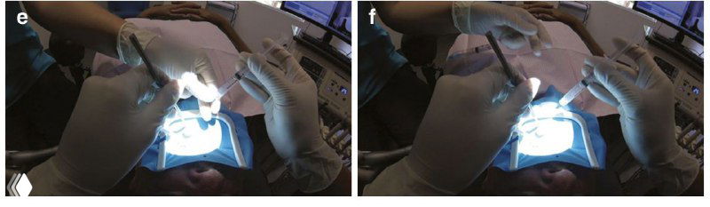 Финальная сцена: ассистент подводит кончик иглы в свет микроскопа так, чтобы выступы коснулись пальцев оператора, демонстрация контроля давления.