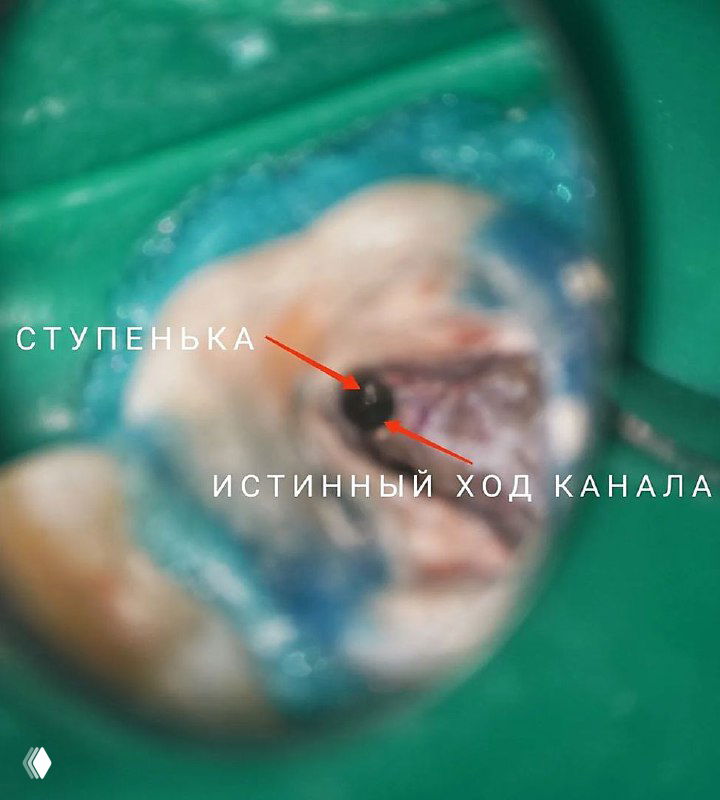 Микроскопический крупный план зуба с отмеченной светлой ступенью и тёмной точкой — вид для поиска истинного хода корневого канала под микроскопом в клиническом контексте.