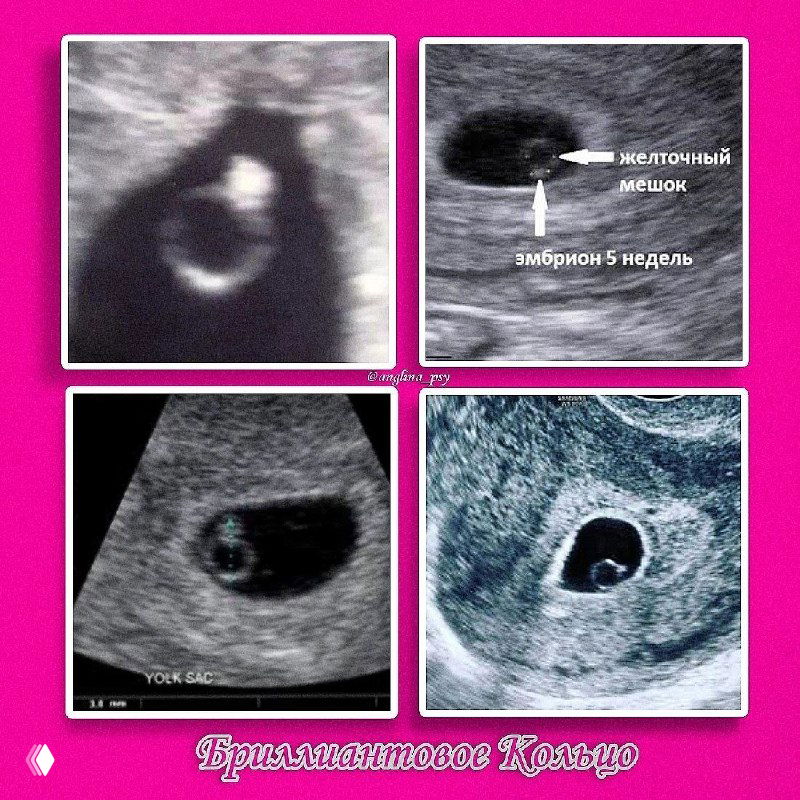 Коллаж из четырёх УЗИ при ранней беременности: видно желточный мешок и крошечный эмбрион, напоминающий «бриллиантовое кольцо».