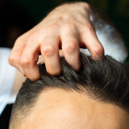 Канал про пересадку волос