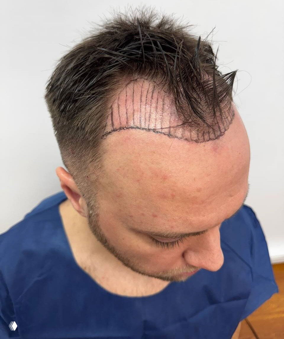 Канал по пересадке волос