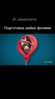 Инфографика: схема подготовки шейки матки фолеем с изображением плода и катетера; медицинская иллюстрация для наглядного объяснения процедуры.