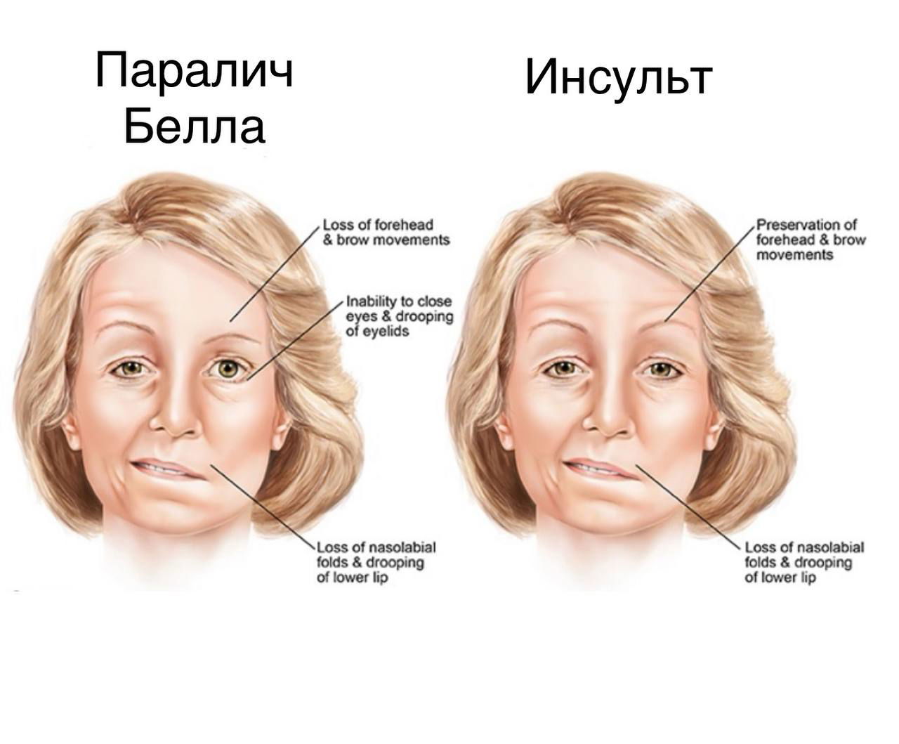 Иллюстрация: сравнение паралича Белла и центрального инсульта — показаны отличия в движении лба, закрывании глаза и опущении угла рта.